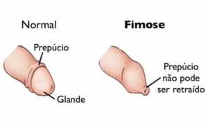 Fimose